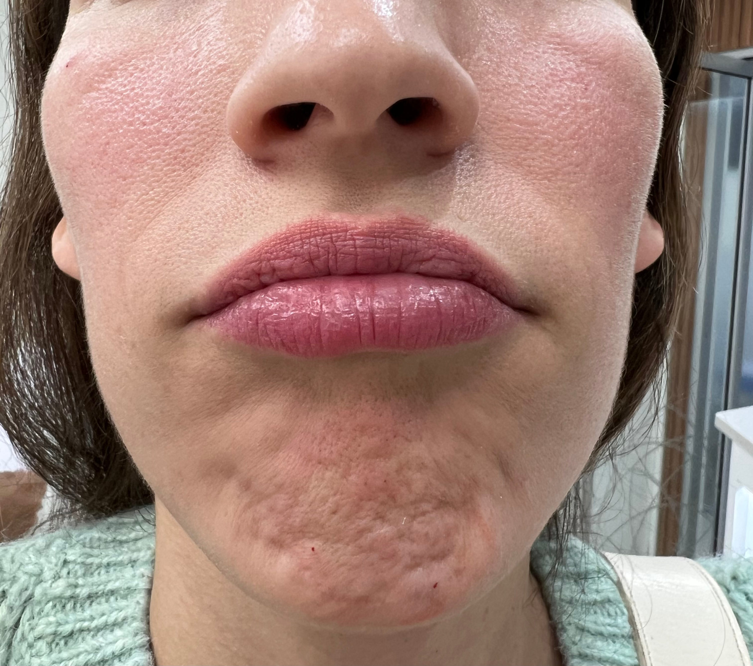 Celulitis del mentón con botox1