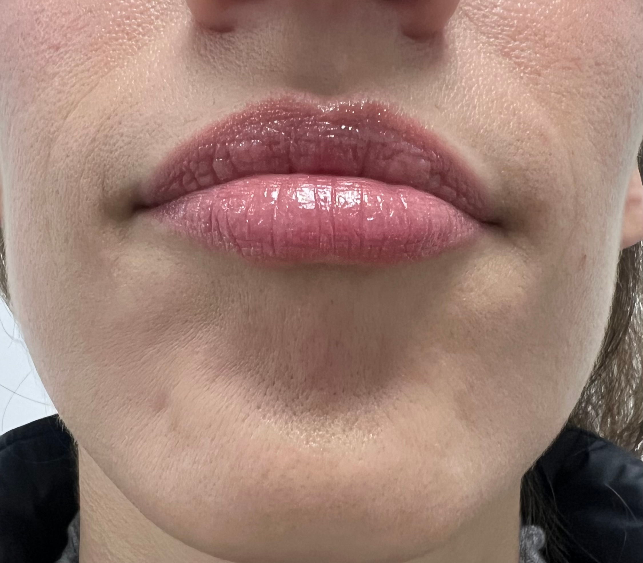 Celulitis del mentón con botox2